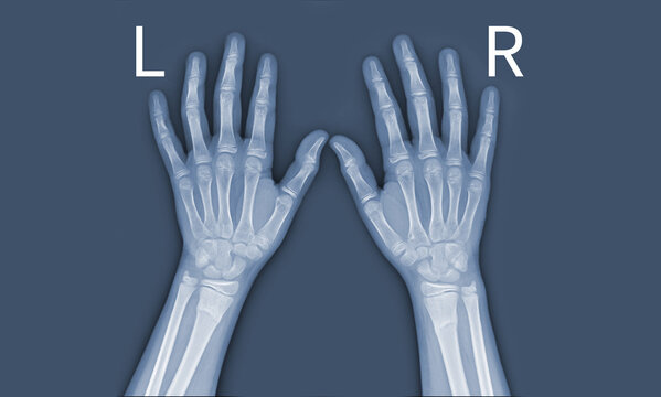 x-ray images of the both hand and wrist joint ap views to see injuries tendons and radius bond fracture for a medical diagnosis.Medical image concept and copy space.
