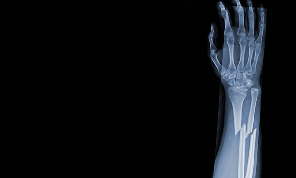 x-ray images of the both hand and wrist joint ap views to see injuries radius and ulna bond fracture for a medical diagnosis.Medical image concept and copy space.