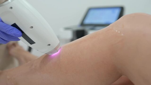 Process of IPL hair removal with laser