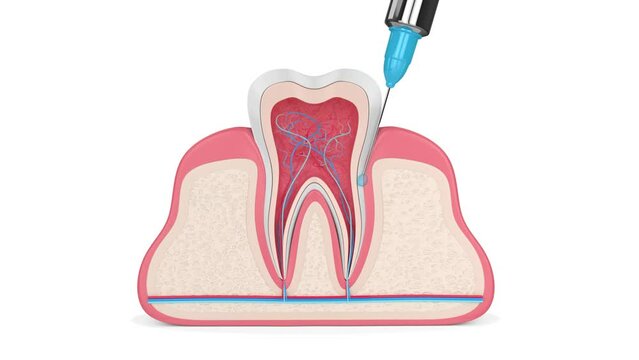 Tooth in gums with intraligamentary anesthesia procedure 