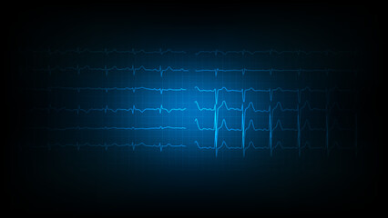 Illustration of heart waves or electrocardiography on display monitoring.