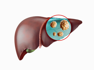 Realistic 3d illustration of cancer of human liver isolated on white - obrazy, fototapety, plakaty