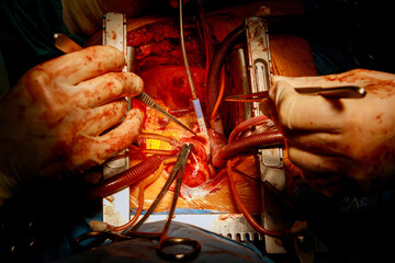 CABG is a type of bypass surgery used for heart operations caused by coronary heart disease in a...