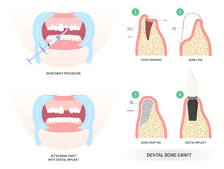 Implant of Teeth bone Graft surgery