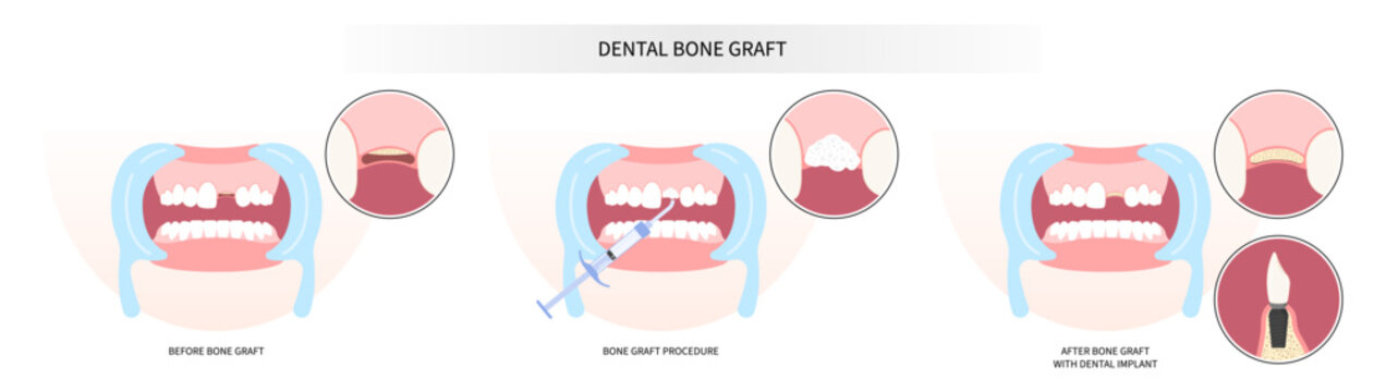 Surgery Of Oral Teeth Bone Graft Procedure