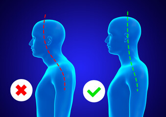 Incorrect and correct posture of the cervical spine of a blue hologram of a man - obrazy, fototapety, plakaty