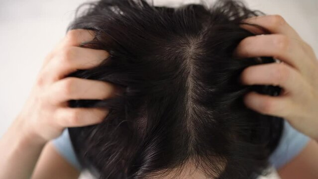 Close Up Of A Woman Strongly Scratches Her Head With Her Hands. Dark Hair With Dandruff. Top View. The Concept Of Diseases Of The Scalp