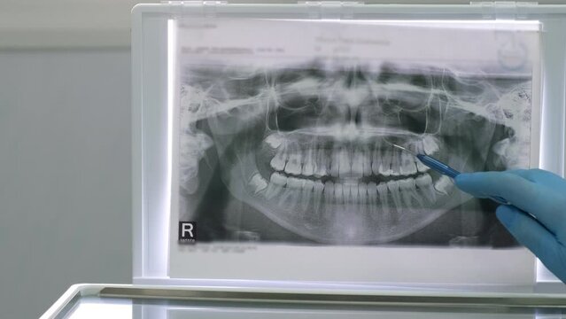 Close up dentist showing to patient teeth x-ray in dental clinic. Dental Xray of jaw with teeth