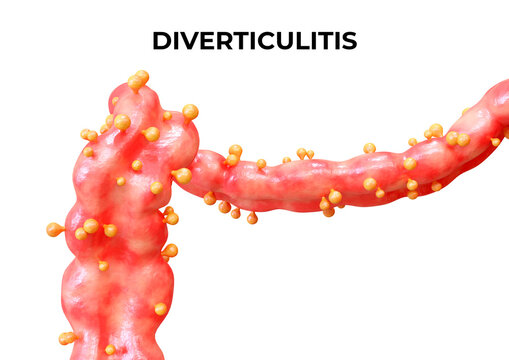 Diverticulitis is a disease that occurs when the diverticula of the large intestine become inflamed or infected, and may present an abscess or perforation