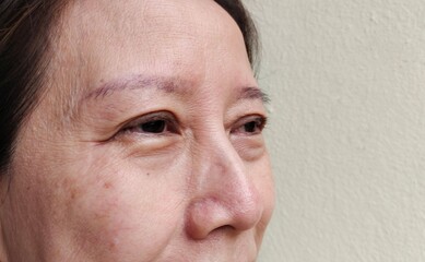 portrait the flabbiness adipose sagging skin and ptosis beside the eyelid, freckles and blemish on the face, dark spots and rough skin under the eyes of the woman, concept health care.