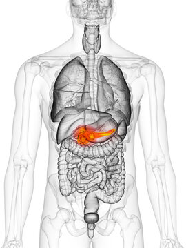 3d rendered, medically accurate illustration of pancreas cancer