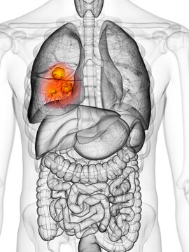 3d rendered, medically accurate illustration of lung cancer