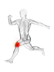 3d rendered medically accurate illustration of a runners painful kee