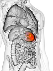 3d rendered, medically accurate illustration of stomach cancer