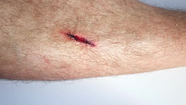 The Wound on a Leg of Young Man. Close Up. Open Red Wound, flows blood, Deep Cut, Dehiscence on Skin. Medical Concept. Laceration Closeup of a large erosion, freshly made, exposed capillaries