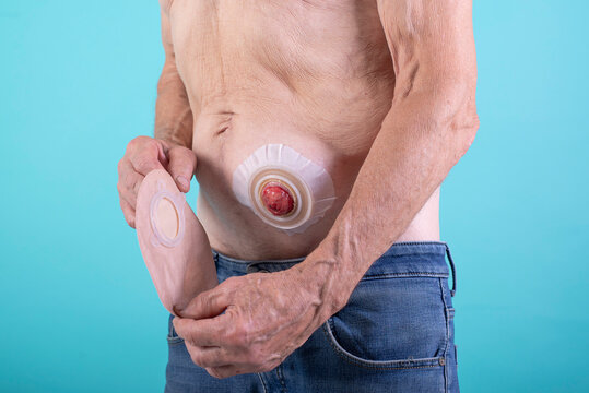 Colostomy Bag Images – Browse 698 Stock Photos, Vectors, and