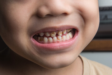 Untreated child's front teeth with plaque and caries, unhealthy baby teeth,
