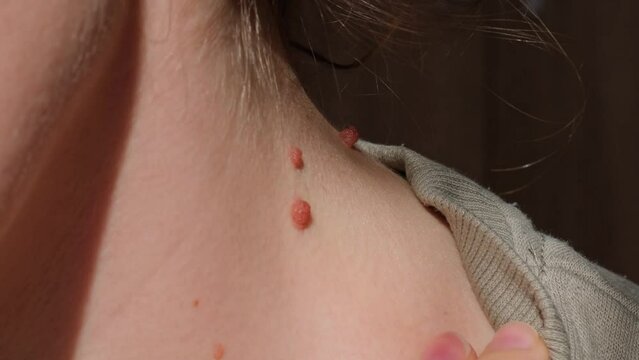 Birthmarks on skin Close up detail of the bare skin Sun Exposure effect on skin, Health Effects of UV Radiation Woman with birthmarks Pigmentation and lot of birthmarks. Skin problems UV radiation