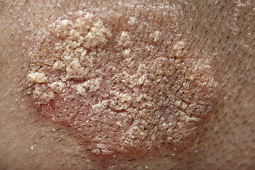 Eczema caucasian male head back