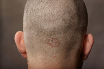 Fototapeta premium Eczema caucasian male head back