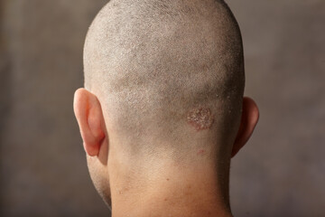 Eczema caucasian male head back