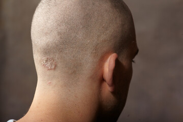 Naklejka premium Eczema caucasian male head back