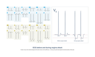 During the attack of angina pectoris, the degree of ST segment depression increased, and the T wave was inverted. Compared with the ST-T before the attack, it showed a dynamic change feature.