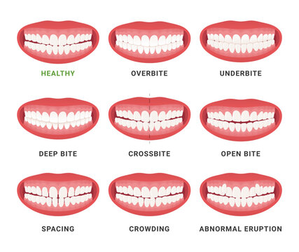 Human mouth jaws medical bad bite and healthy scheme with names set vector flat