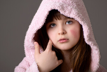 Obraz premium Food allergy in a young child on the cheeks , little girl has eczema on her face.