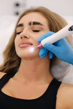 Macro close up detail of laser plasma pen removing facial wart on young woman. Noninvasive cosmetic treatment