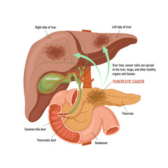 Pancreatic cancer. Spread of cancer cells from the pancreas to the liver