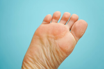 Close-up of dry feet. Dry skin problem.