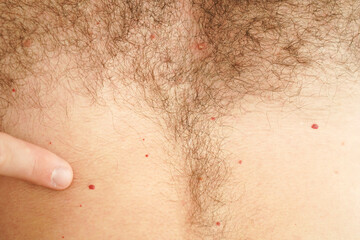 Fototapeta premium Close-up of a man's hairy chest. A pustule on the human body.