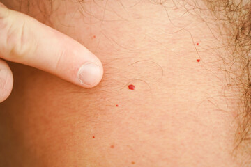 Fototapeta premium A red birthmark on a human body.