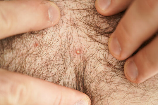 Close-up of a man's hairy chest. A pustule on the human body.