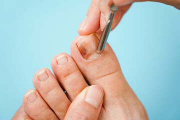 Close-up of problematic nails. Nail disease. The process of performing a pedicure with nail...