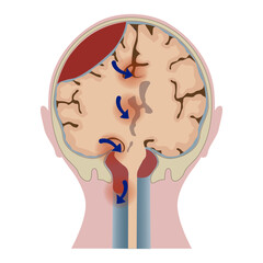 Brain hematoma with tissue distortion. Sectioned head. Medical poster. Vector illustration