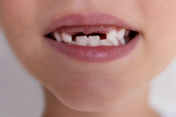 Close-up of a child's mouth without milk front teeth.