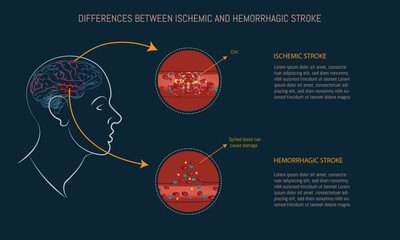 Differences between ischemic and hemorrhagic stroke. Brain silhouette and infographic of the two types of stroke on blue background.