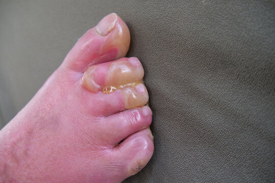 Close up of water blisters on the toes of paraplegic after serious hot water burn