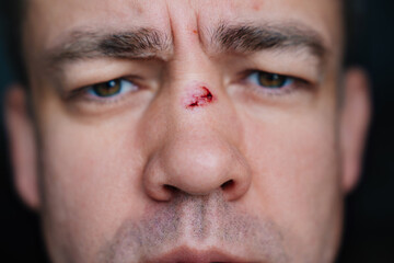 Obraz premium close-up. bloody abrasion on the bridge of the nose of a man after a blow. 
