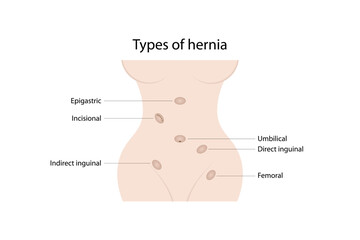 Types of hernia. Epigastric, incisional, direct inguinal, indirect inguinal, umbilical, femoral hernias. - obrazy, fototapety, plakaty