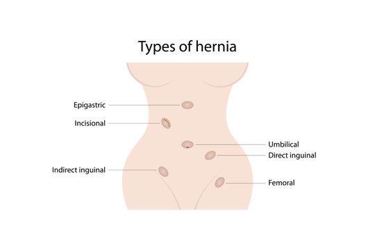 Femoral Hernia Images – Browse 14 Stock Photos, Vectors, and
