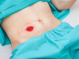 Belly of a young Caucasian male patient in a turquoise disposable medical pajamas with a protruding...