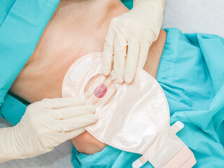 A patient in pajamas with an open abdomen, protruding intestine with a colostomy bag.