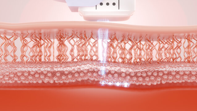 HIFU laser treatment shot laser deep to SMAS to enhancing the radiance, firmness and suppleness of skin. 3D rendering.