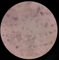 Microscopic fungi Malassezia furfur, showing yeast cells and hyphae. They are associated with...