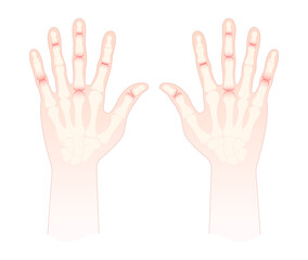 chronic Hand Pain joint inflammatory with facial butterfly and malar rash hair loss kidney failure of Raynaud disease face purple or pale