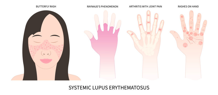 Butterfly And Malar Rash Chronic Facial Pain Joint Inflammatory Hair Loss Kidney Failure Raynaud’s Disease Face Purple Pale