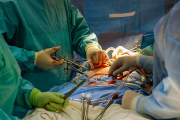 Procedure of coronary artery bypass graft CABG for the operation a heart due to coronary heart...